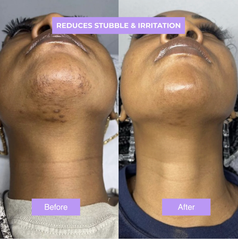 Cyperusglow™ – Cyperus Rotundus Skin Serum